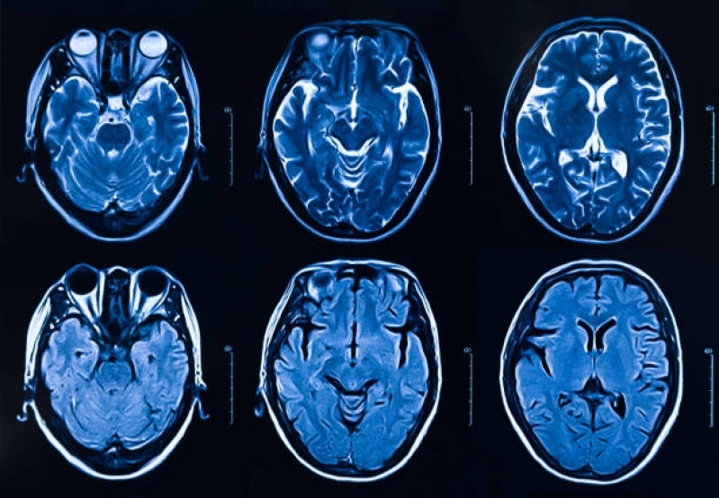 NEUROIMAGEM, RESSONÂNCIA MAGNÉTICA, SISTEMA NERVOSO CENTRAL, MRI, PRINCÍPIOS DA RESSONÂNCIA MAGNÉTICA, APLICAÇÕES CLÍNICAS, PESQUISA NEUROCIENTÍFICA, DESAFIOS E AVANÇOS, CONCLUSÃO, IMAGENS CEREBRAIS.