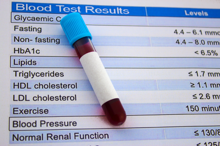 Perfil Lipídico e Além Exames de Sangue que Avaliam Riscos Cardiovasculares