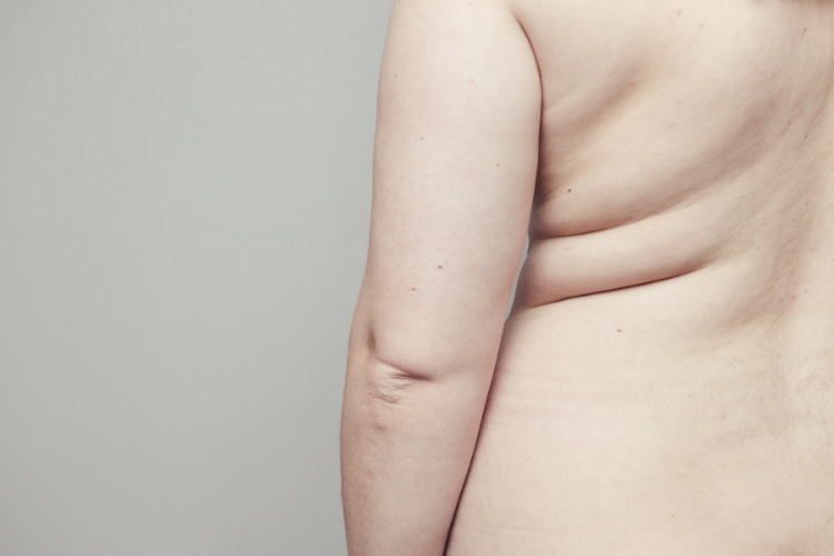 lipedema sintomas e tratamento
