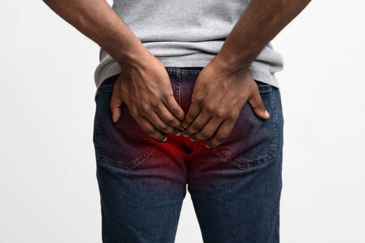 Hemorroidas externas causas e tratamentos