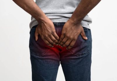 Hemorroidas externas causas e tratamentos