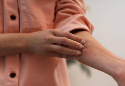 Picada de inseto pomadas para aliviar sintomas