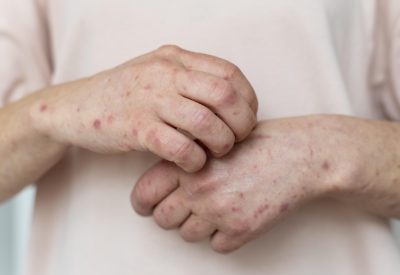 sarna em humanos como tratar